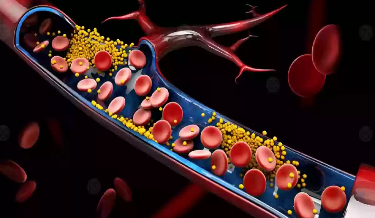 ارتفاع الكوليسترول
